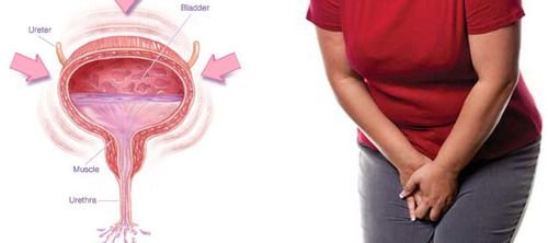 How to Prevent and Treat Overactive Bladder Symptoms