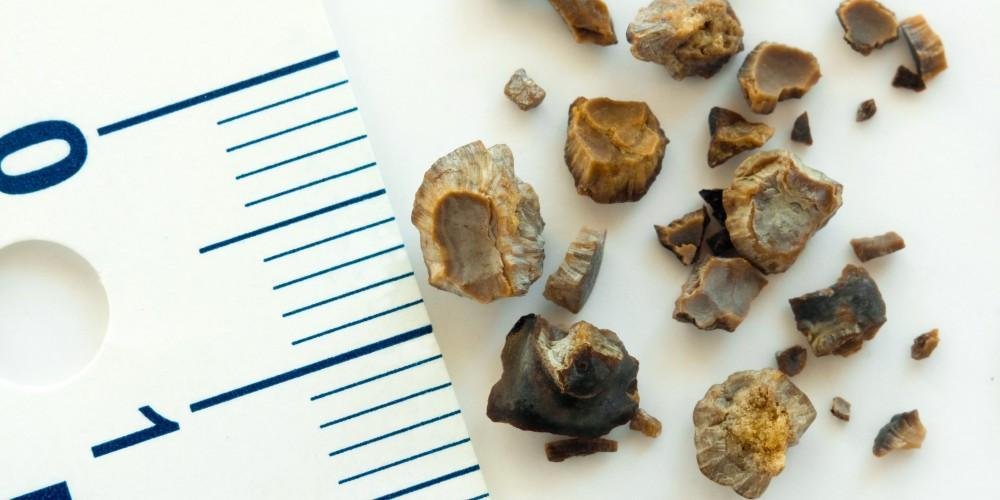 Calcium and Kidney Stones: Myths vs. Facts