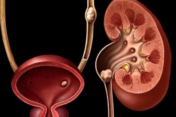 How Are Kidney Stones Diagnosed?