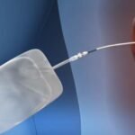 How to Recover After Kidney Stone Surgery