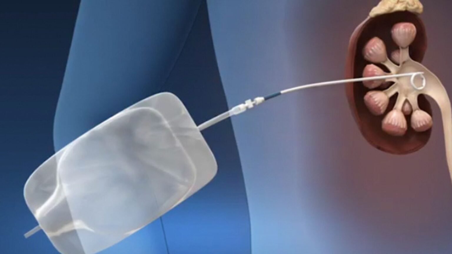 Fresh Look at How To Recover After Kidney Stone Surgery