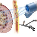 Minimally Invasive Procedures for Kidney Stones