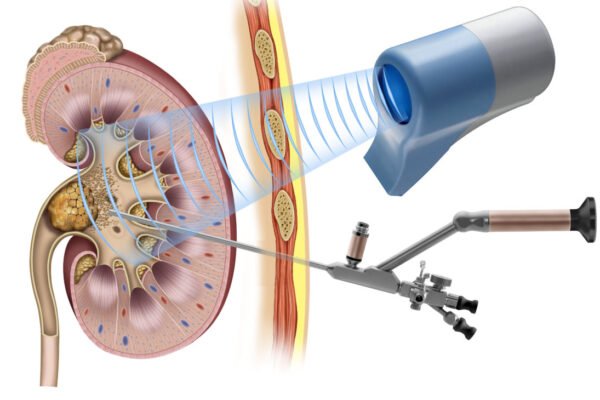 Minimally Invasive Procedures for Kidney Stones