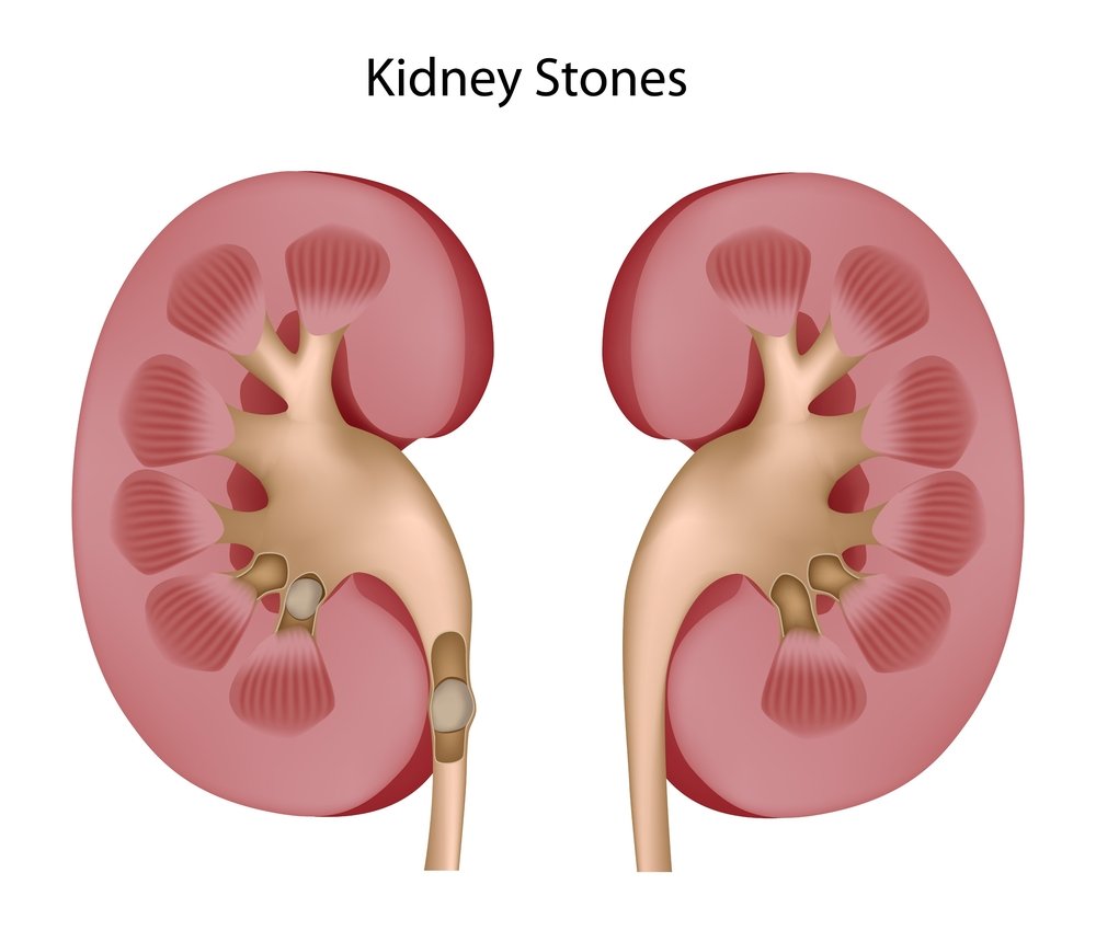 Kidney Stones and Pain Management: What You Need to Know