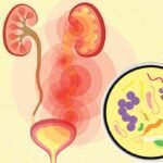 What Is a Urinary Tract Infection (UTI) and How Do You Get It?