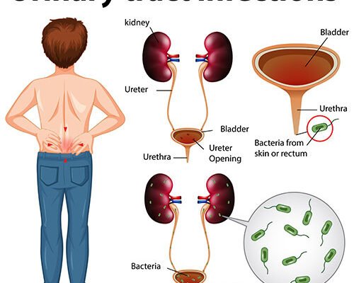 The Most Common Symptoms of a UTI and How to Identify Them