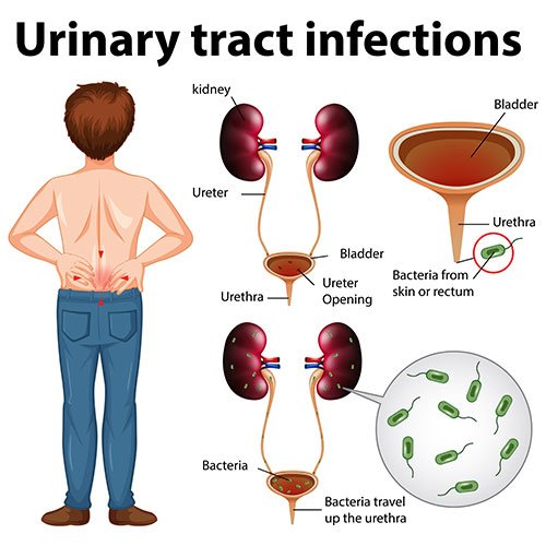 The Most Common Symptoms of a UTI and How to Identify Them