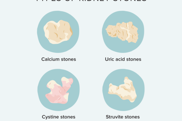 The Different Types of Kidney Stones and How They Differ