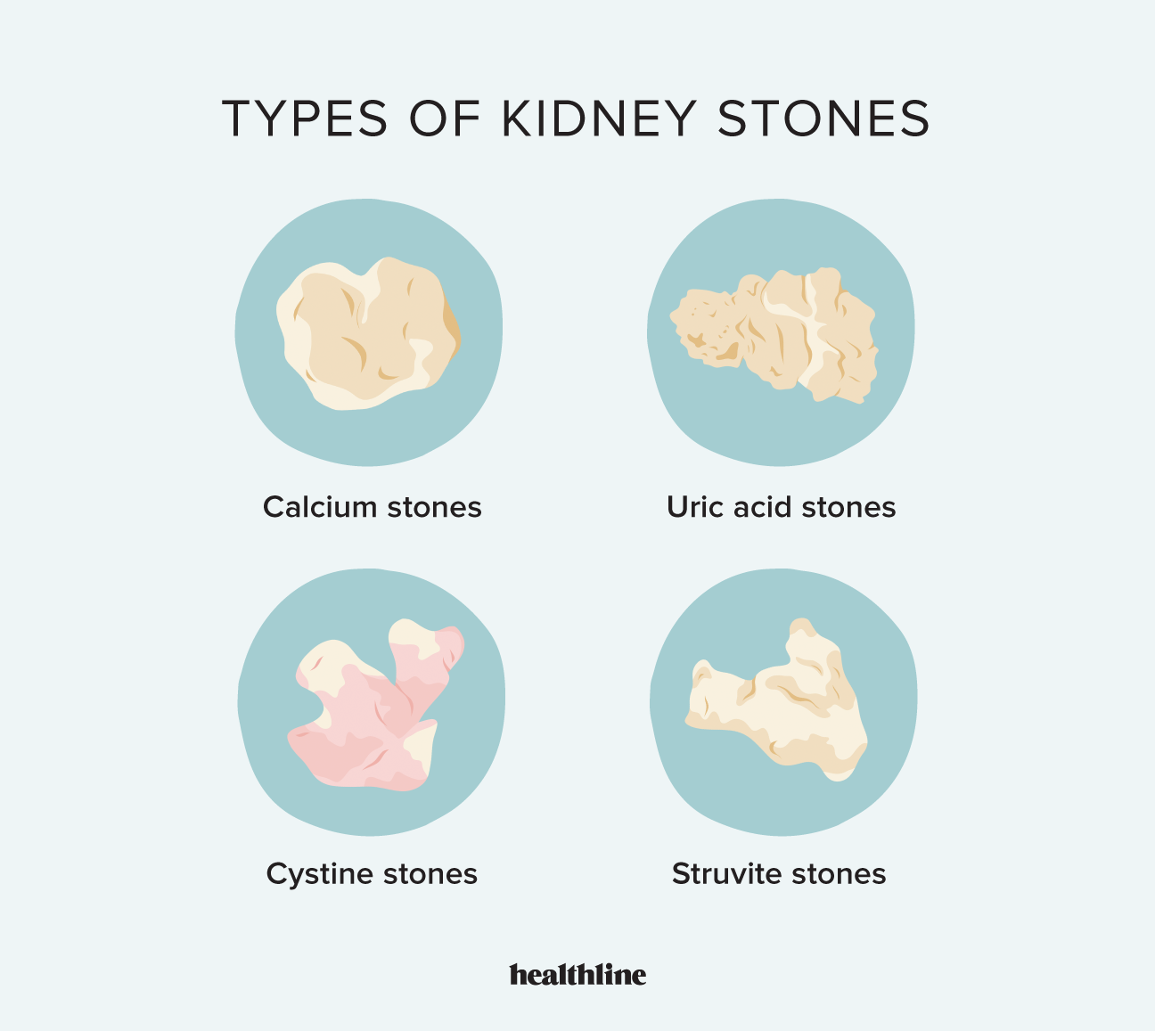 The Different Types of Kidney Stones and How They Differ