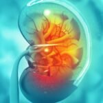 The Connection Between Kidney Stones and Hypertension