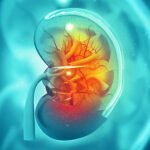 Treatment Options for Kidney Stones