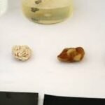 Understanding the Different Types of Kidney Stones