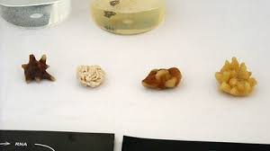 Understanding the Different Types of Kidney Stones