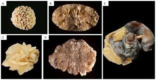 Understanding the Different Types of Kidney Stones