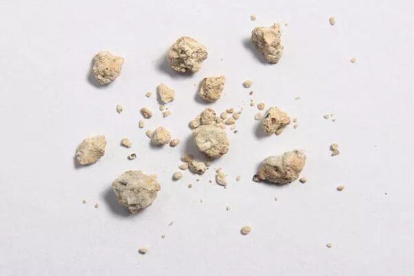 What Causes Kidney Stones and How to Prevent Them