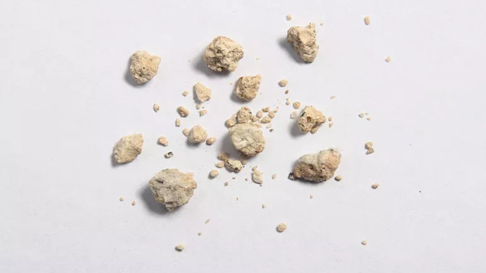 What Causes Kidney Stones and How to Prevent Them