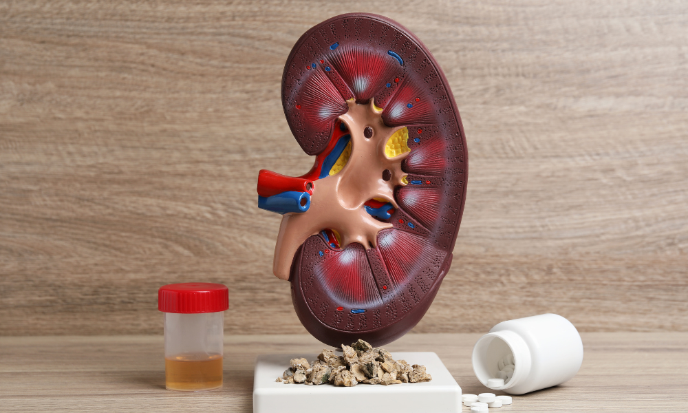 What Causes Kidney Stones?