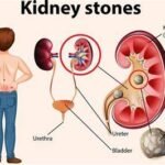Recover After Kidney Stone Surgery