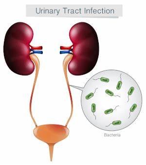 The Connection Between UTIs and Dehydration