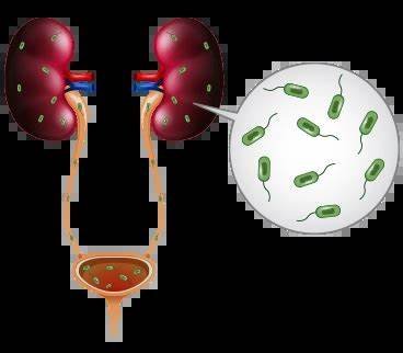 The Impact of UTIs on Kidney Health