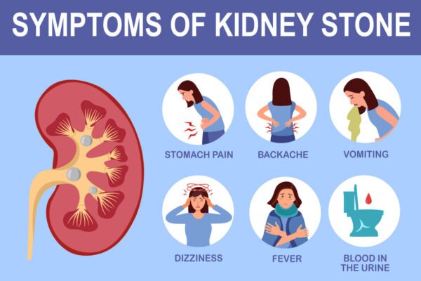 Signs and Symptoms of Kidney Stones